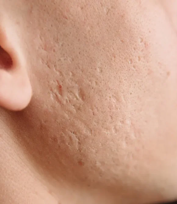 Acne Scars and Blemishes in Elk Grove, CA