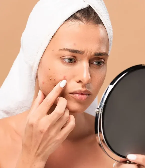 Acne in Elk Grove, CA