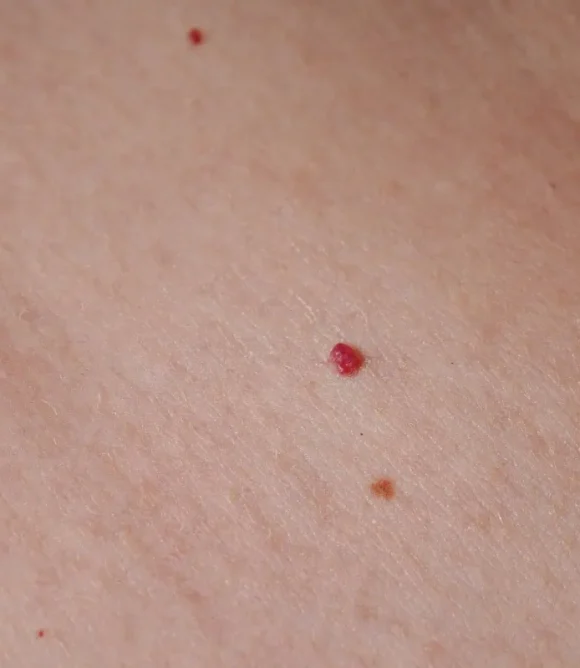 Angiomas in Elk Grove, CA