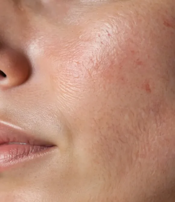 Crepey Skin and Superficial Wrinkles in Elk Grove, CA