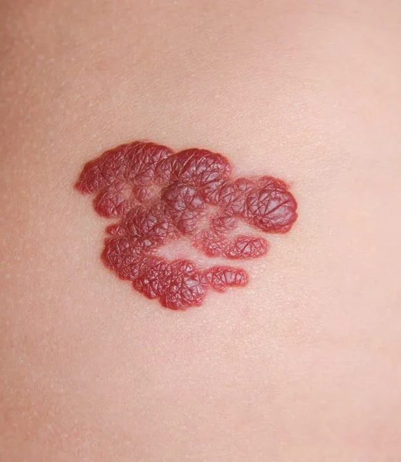 Hemangiomas-Blood-Vessel-Growth-Treatment-in-Elk-Grove-CA