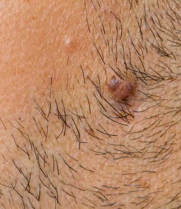 Ingrown-Hair-Razor-Bumps-Treatment-in-Elk-Grove-CA