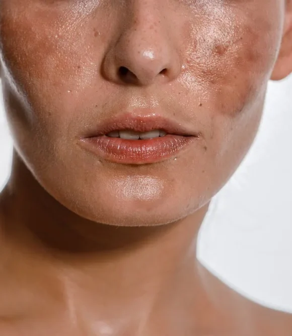 Melasma-and-Dark-Spots-Treatment-in-Elk-Grove-CA