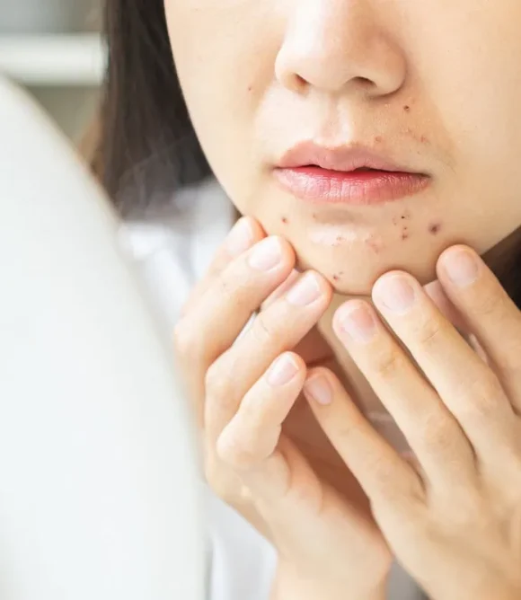Pimples in Elk Grove, CA