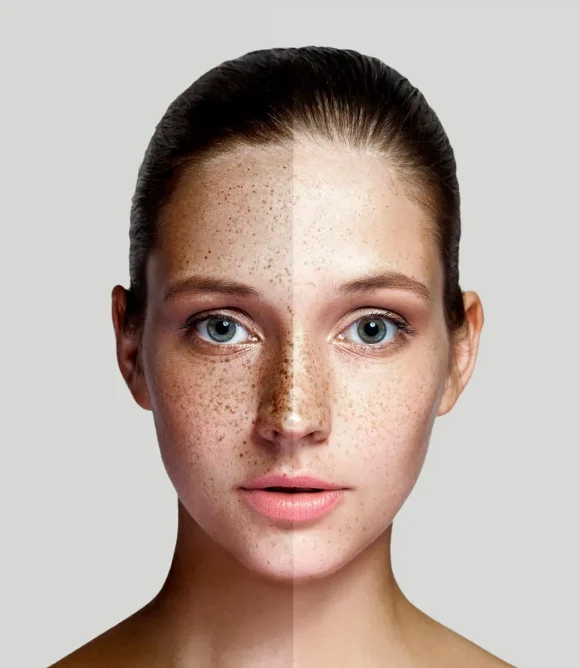 Post-Acne Marks and Pigmentation in Elk Grove, CA