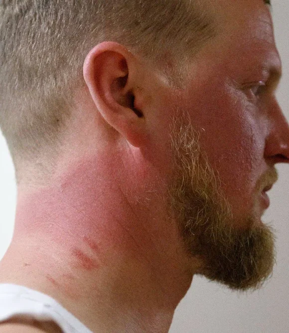 Redness-Sun-Damage-and-Skin-Maintenance-Treatment-in-Elk-Grove-CA