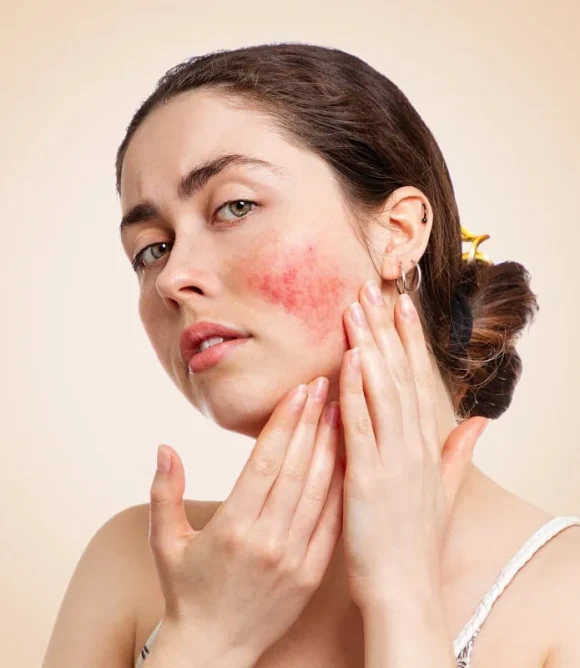 Rosacea in Elk Grove, CA